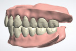 Fig 13. The designed digital dentures articulated as viewed from the right, frontal, and left.