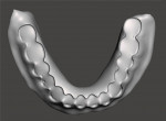 Fig 22. The virtual mandibular denture base that was designed as viewed from the cameo (tooth side) and intaglio (tissue) views.