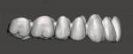 Fig 24. The designed digital denture teeth for the maxillary arch as viewed from the right, frontal, and left.