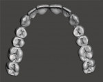 Fig 27. The designed digital denture teeth for the maxillary arch as viewed from the occlusal and gingival aspects.