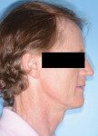 Fig 2. Pretreatment, lateral facial.