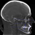 Fig 3. Pretreatment, reconstructed lateral cephalometric.
