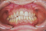Fig 4. Pretreatment, intraoral situation.