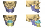 Fig 6. Virtual surgical planning showing preoperative 3D CT imaging (top two images) and planned surgical bony changes (bottom two images).