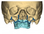 Fig 9. 3D-printed plates and planned screw lengths for the maxilla.
