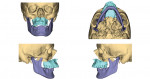 Fig 10. Position of the maxilla after advancement relative to the native position of the mandible, demonstrating 10 mm advancement, 3 mm midline correction to the right, and slight yaw rotation.