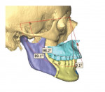 Fig 11. Position of the mandible after advancement relative to the previously advanced maxilla, or the final planned surgical occlusion.