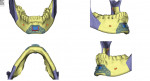 Fig 12. Genial tubercle advancement cutting guide and final position, resulting in an advancement of the genioglossal attachments of 6 mm.