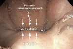 Fig 1 and Fig 2. Drug-induced sleep endoscopy (DISE) images depicting two different collapse patterns of the soft palate or velum. A nasolaryngoscope has been inserted through the nose and advanced into the nasopharynx. The posterior nasopharynx wall and soft palate as viewed from the nasal side are depicted. Fig 1 shows A-P oriented palate collapse against the nasopharyngeal wall, while Fig 2 shows concentric collapse of the velum.