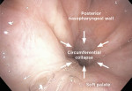 Fig 1 and Fig 2. Drug-induced sleep endoscopy (DISE) images depicting two different collapse patterns of the soft palate or velum. A nasolaryngoscope has been inserted through the nose and advanced into the nasopharynx. The posterior nasopharynx wall and soft palate as viewed from the nasal side are depicted. Fig 1 shows A-P oriented palate collapse against the nasopharyngeal wall, while Fig 2 shows concentric collapse of the velum.