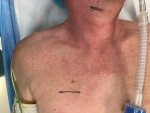 Fig 4. Planned neck and chest incisions.
