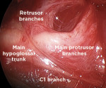 Fig 5. Main trunk of the hypoglossal nerve in submandibular triangle as it divides into the C1, main protrusor, and retrusor branches.