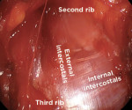 Fig 8. Exposure of the intercostal space between the second and third ribs showing the junction of the internal and external intercostal muscles.
