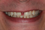 Fig 1. Pretreatment frontal view of smile. Note large diastema between teeth Nos. 8 and 9.