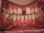 Fig 3. Pretreatment, patient in maximum intercuspation showing wear consistent with a frictional or constricted chewing pattern.