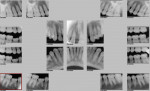 Fig 4. Pretreatment full-mouth x-ray.