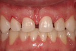 Fig 6. Minimally invasive porcelain veneer preparations on teeth Nos. 7 through 10.