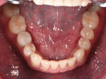 Fig 11. Mandibular occlusal view 14 years post-treatment. Note no wear on unrestored incisal edges of the anterior teeth.