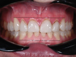 Fig 12. Gingival levels 14 years post-treatment. Note supraeruption of teeth Nos. 7 through 10 (especially No. 9) and Nos. 23 through 26 (as indicated by the black horizontal lines).