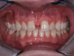Fig 15. Significant maxillary labial frenum visible at the patient’s midline.