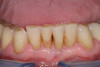 Figure 1  Lingualized posterior occlusion: maxillary complete denture with anatomical teeth (Vitapan® Cuspiform 23° to 28°).