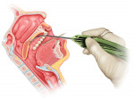 Fig 1. Initial penetration with the insertion device and attached barbed suture, left of the midline, sagittal view.