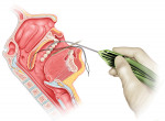 Fig 4. Withdrawal of the insertion device, leaving barbed suture buried in place.