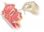 Fig 6. Activation of barbed suture to stiffen and compress the soft palate