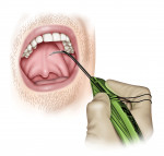 Fig 8. Initial penetration with the insertion device and attached barbed suture, left of the midline, oblique view.