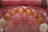 Figure 2  Lingualized posterior occlusion: mandibular stress-broken, two-implant bar overdenture with abraded teeth (Vitapan<sup>®</sup> Synoform 0° to 5°).