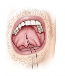 Fig 10. Upon removal of insertion device, barbed suture is buried, activation suture in place.