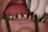 Figure 4  Lingualized posterior occlusion: Vitapan<sup>®</sup> anterior and posterior teeth.