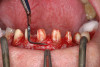Figure 8  Completed dentures using the Filou 28 Denture set-up system and Mondial<sup>®</sup> anterior and posterior teeth.
