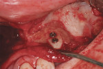 Figure 23  View of block chin graft placed in area of No. 10 in preparation for implant placement.