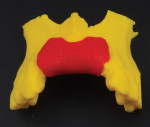 (1.) A dual-color FFF 3D-printed diagnostic model of a patient’s maxilla (yellow) and the area that will receive bone grafting (red).