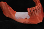 (6.) An FFF 3D printed diagnostic model of a patient’s mandible (red) being used during presurgical planning to determine the shape, size, and adaptation of a collagen membrane that will be placed (white).