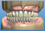 Fig 6. The proposed tooth arrangement is shown within the prosthetic space. Note that the mandibular posterior teeth are set at two-thirds the height of the retromolar pad using anatomical landmarks for establishing the plane of occlusion for improved function.