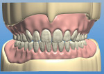 Fig 8. The denture base is built with proper peripheral extensions according to border-molded impressions.