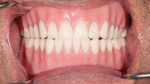 Fig 19. The denture insertion with a view in centric occlusion. No adjustments to the base or occlusion were necessary.