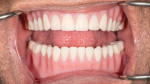 Fig 20. The denture insertion shows superior adaptation and retention when the patient opens wide and the dentures stay in place.