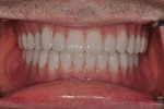 FIG. 2: Full-mouth dentures in the patient’s mouth.