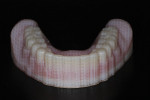Fig 12. The mandibular denture is removed after printing, showing the support structure covering the teeth and base that eliminates variables of distortion.
