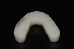 Fig 13. The mandibular denture intaglio surface is dimensionally supported, creating a high-fidelity fit for the denture base.