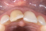 Fig 3. Preoperative incisal view.