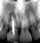 Fig 4. Preoperative periapical radiograph of failing tooth No. 8.