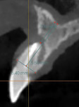 Fig 5. Sagittal CBCT view of failing tooth No. 8.