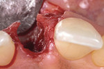 Fig 10. Incisal view of the extraction socket showing facial bone defect, but intact proximal bone.