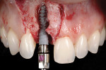 Fig 11. A 3.5 mm x 13 mm implant was placed immediately into the extraction socket.