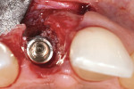 Fig 12. Incisal view showing the implant immediately placed within and palatal to the extraction socket.