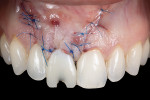 Fig 15. Facial full-thickness flap was repositioned and primary closure was achieved with sutures.